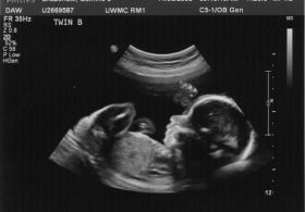 Ali je ultrazvok škodljiv?