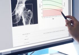 Največ škode in največ koristi za svoje kosti lahko naredimo pozimi! Navade, prehrana in dopolnila
