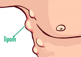 Maria Ana odgovarja: Lipomi po rokah in nogah