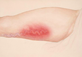 Maria Ana odgovarja: Težave s kapilarami