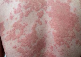 Psoriaza in rdeča svetlobna terapija ali fotobiostimulacija