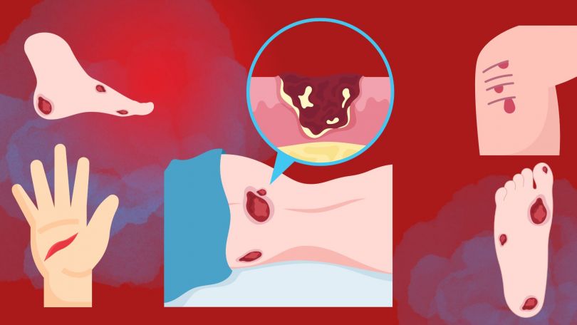 Celjenje ran: kako dramatično pospešiti proces celjenja?