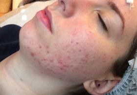 Brez dragih krem do čiste kože na obrazu - BREZ MOZOLJEV!