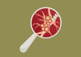 Novi izsledki o raku na konferenci za efektivno medicino