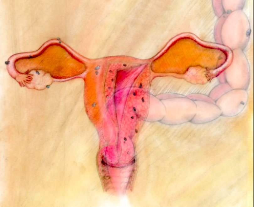 Praktično takojšnja rešitev pri menstrualnih krčih!
