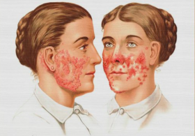 Maria Ana odgovarja: Zbolela sem za lupusom