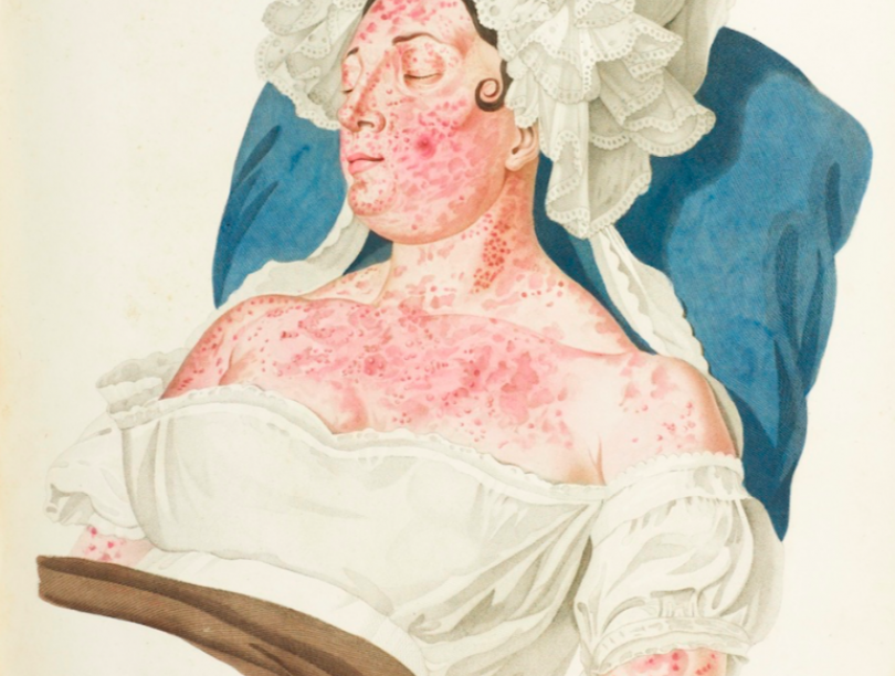 Maria Ana odgovarja: Kaj pomaga proti luskavici?