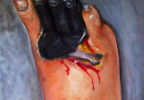 Maria Ana odgovarja: diabetes in rana na nogi