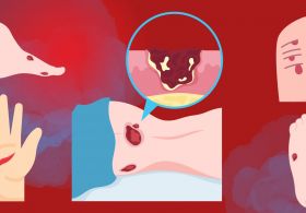 Celjenje ran: kako dramatično pospešiti proces celjenja?