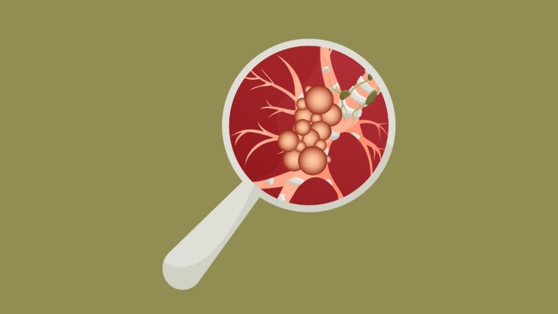 Novi izsledki o raku na konferenci za efektivno medicino