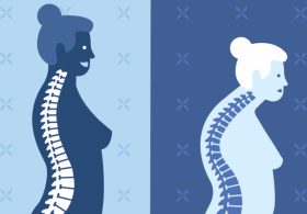 Osteoporoza? Tukaj so rešitve!