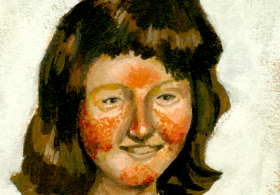 Maria Ana odgovarja: diagnoza − Rosacea
