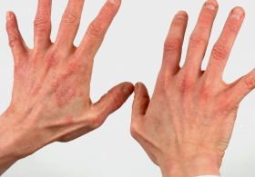 Boj proti atopijskemu dermatitisu