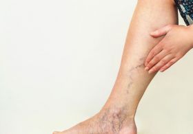 Krčne žile? Ustavite jih na naraven način!