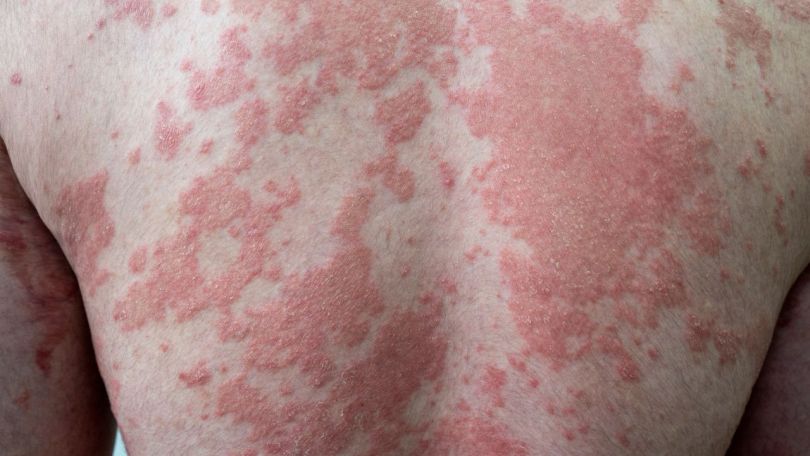 Psoriaza in rdeča svetlobna terapija ali fotobiostimulacija