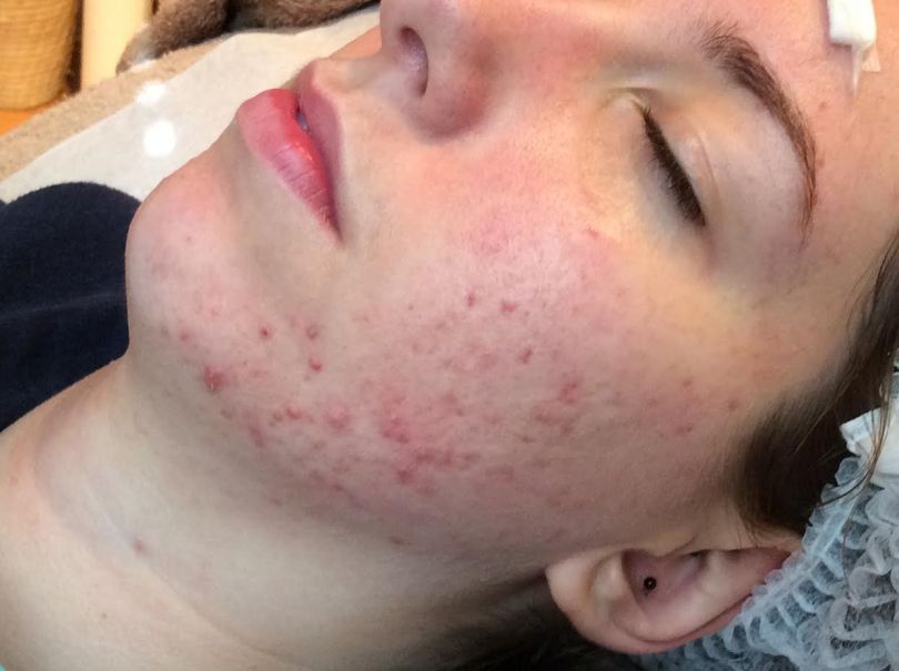 Brez dragih krem do čiste kože na obrazu - BREZ MOZOLJEV!