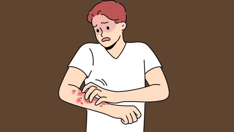 Naravno zdravljenje kože brez kortikosteroidov s pomočjo rdeče svetlobne terapije